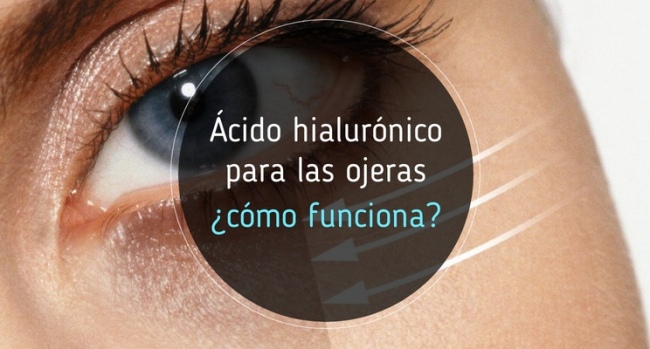 Ácido hialurónico para las ojeras, ¿cómo funciona?