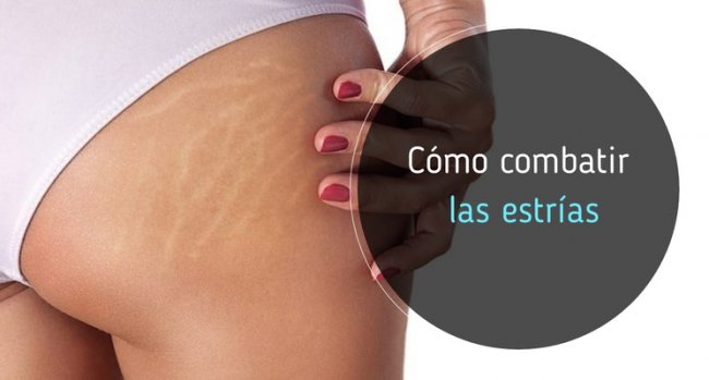 Cómo combatir las estrías: Consejos y mejores cremas