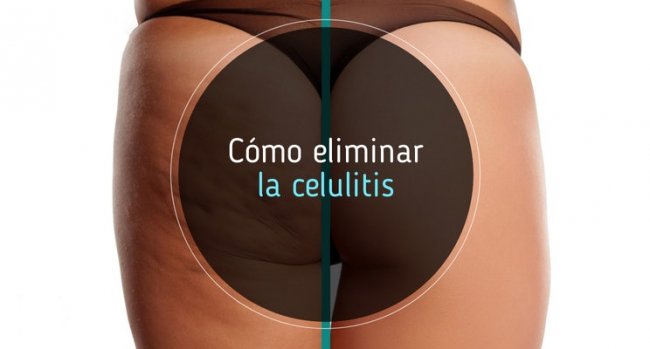 Como eliminar la celulitis