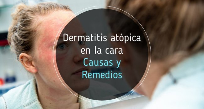 Dermatitis atópica en la cara: causas y remedios
