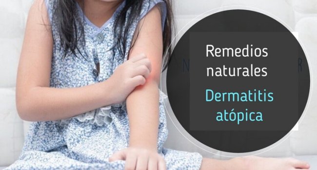 Dermatitis atópica: remedios naturales