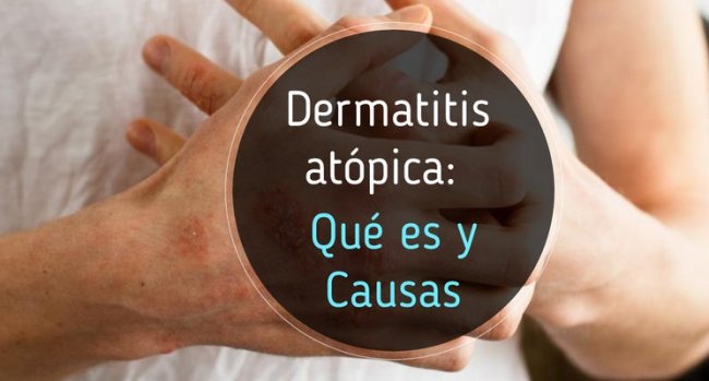 Piel con dermatitis atópica: qué es y sus causas